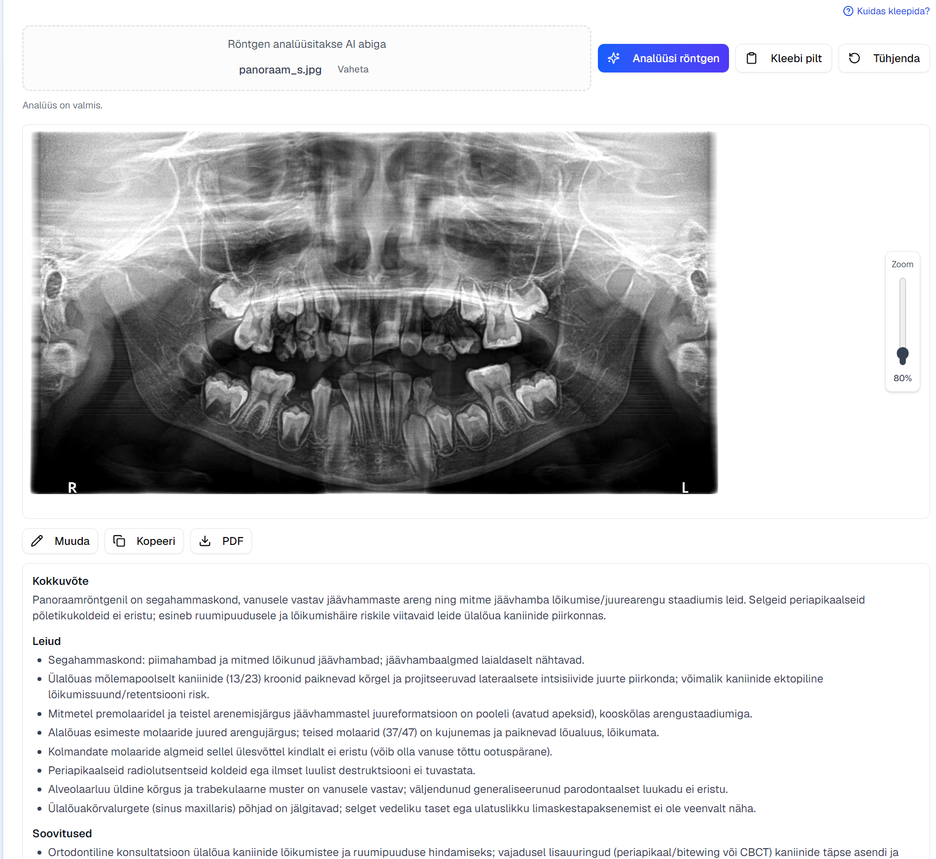epikriis.ee röntgenipildi AI-analüüsi tulemus detailse leidude ülevaatega